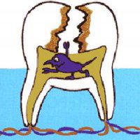 Пульпит зуба. Симптомы и лечение